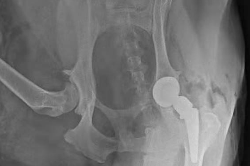 How should pet owners decide to undergo hip replacement surgery?